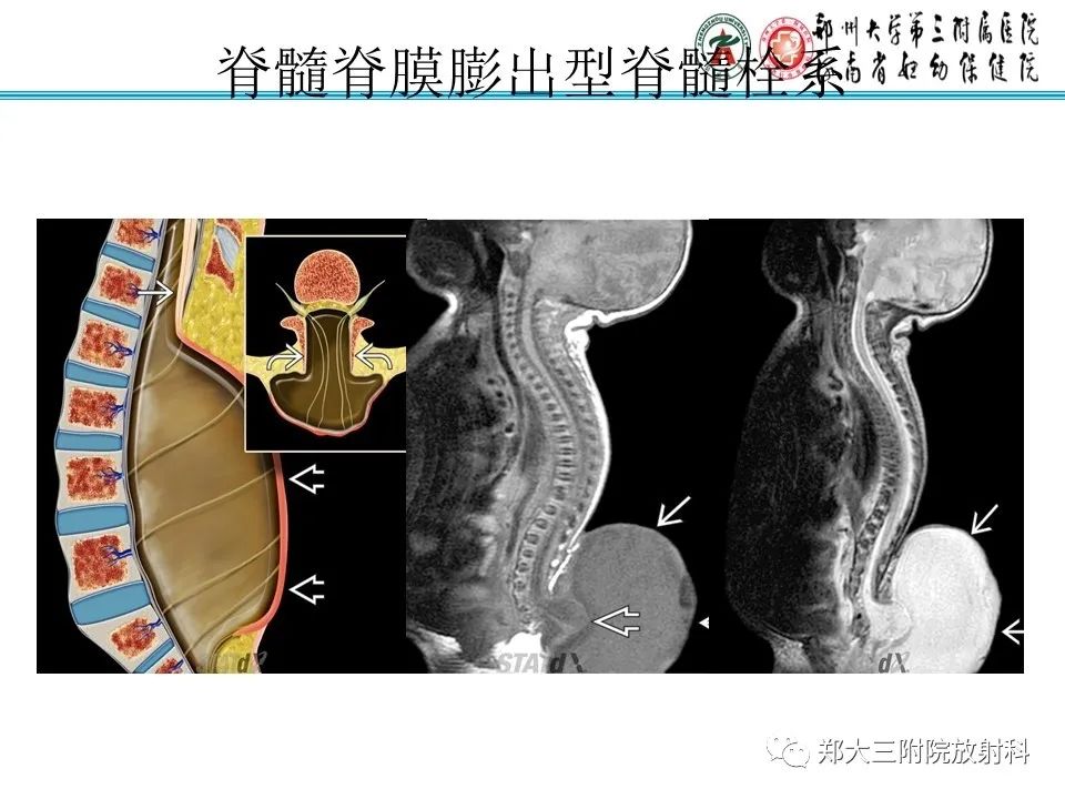 影像PPT - 【PPT】脊髓栓系综合征-19