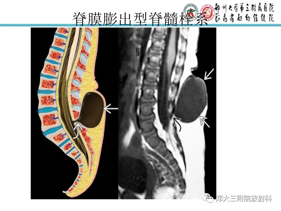 影像PPT - 【PPT】脊髓栓系综合征-18