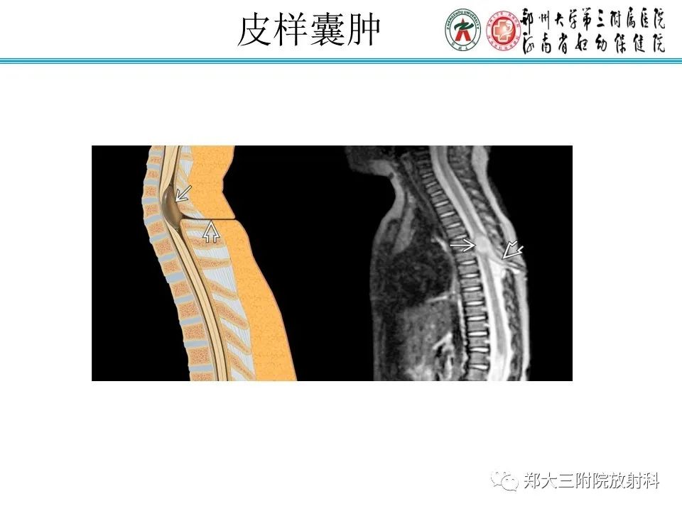 影像PPT - 【PPT】脊髓栓系综合征-20