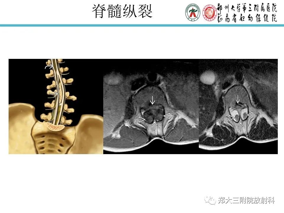影像PPT - 【PPT】脊髓栓系综合征-21