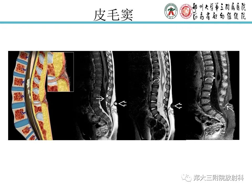 影像PPT - 【PPT】脊髓栓系综合征-22
