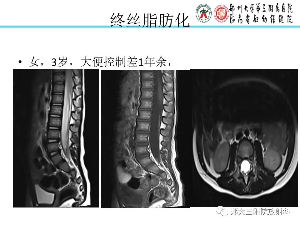 影像PPT - 【PPT】脊髓栓系综合征-24