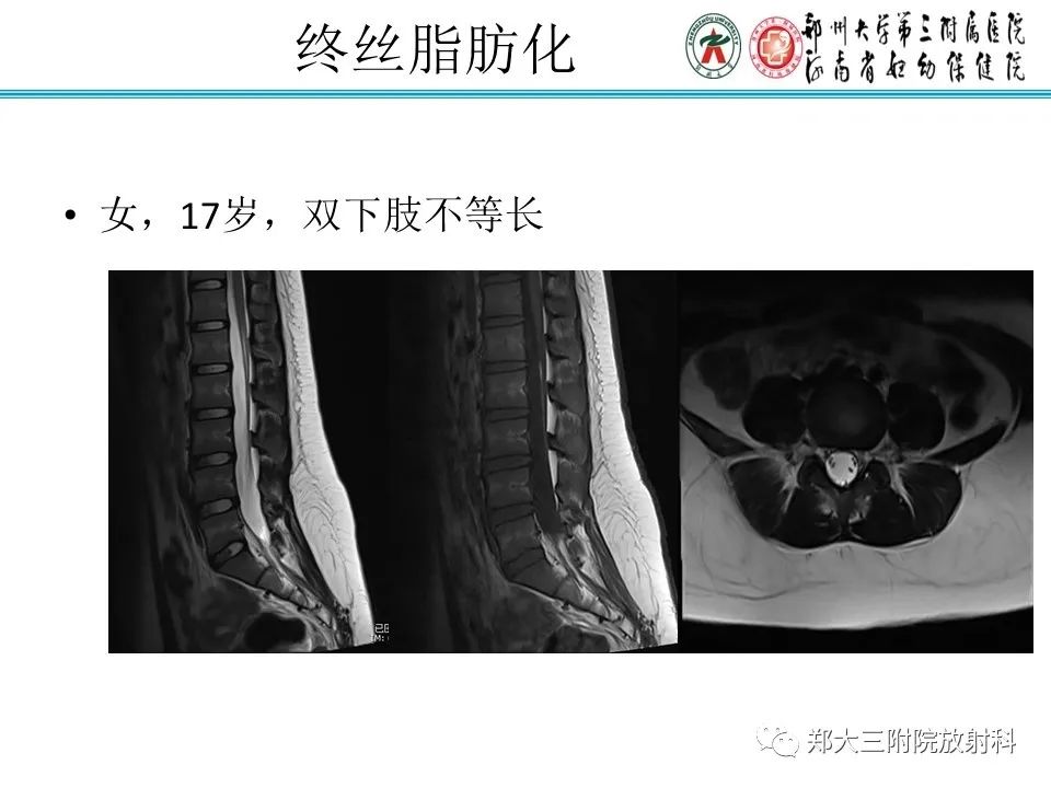 影像PPT - 【PPT】脊髓栓系综合征-25
