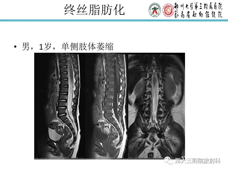 影像PPT - 【PPT】脊髓栓系综合征-26