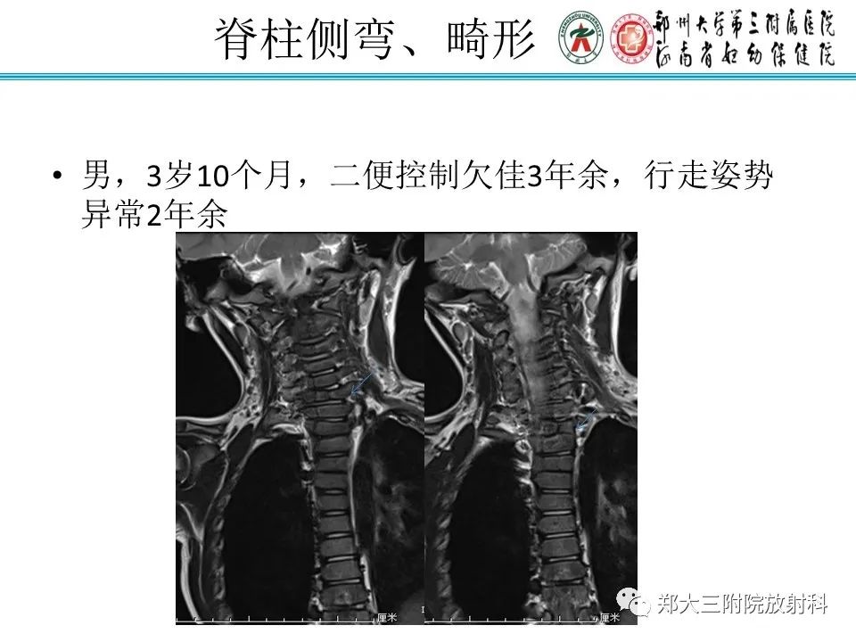 影像PPT - 【PPT】脊髓栓系综合征-27