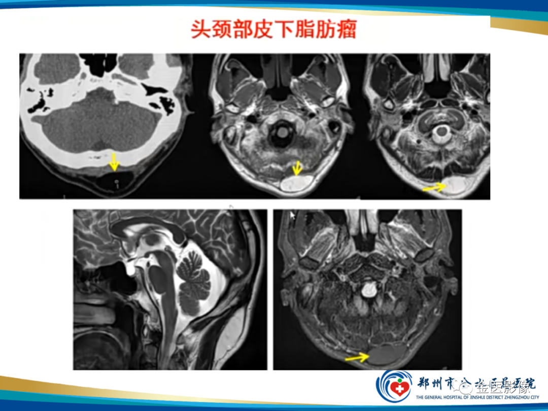 影像PPT - 【PPT】软组织肿瘤影像表现与诊断思路-8