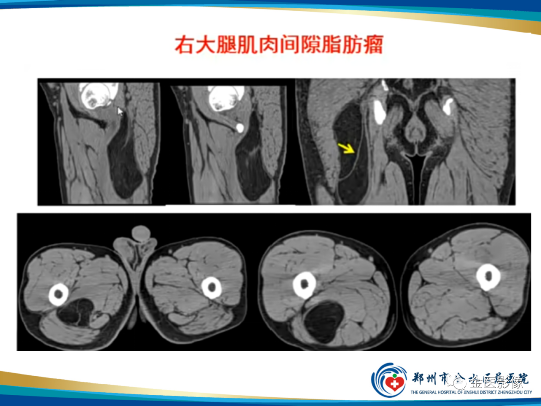 影像PPT - 【PPT】软组织肿瘤影像表现与诊断思路-9