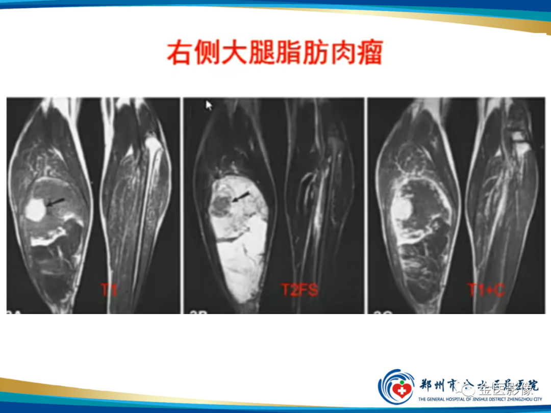 影像PPT - 【PPT】软组织肿瘤影像表现与诊断思路-11