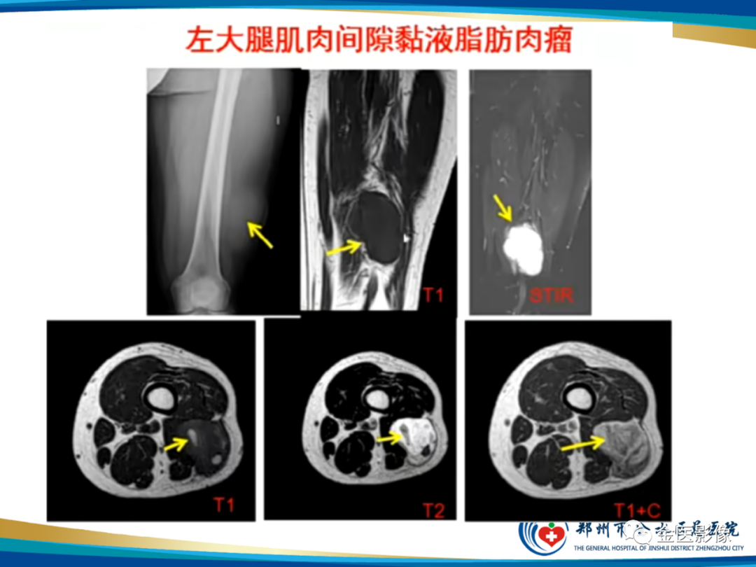 影像PPT - 【PPT】软组织肿瘤影像表现与诊断思路-12