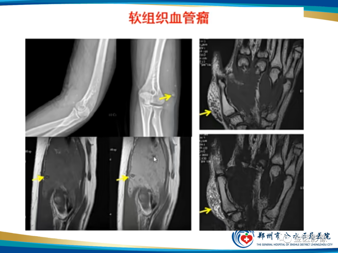 影像PPT - 【PPT】软组织肿瘤影像表现与诊断思路-14