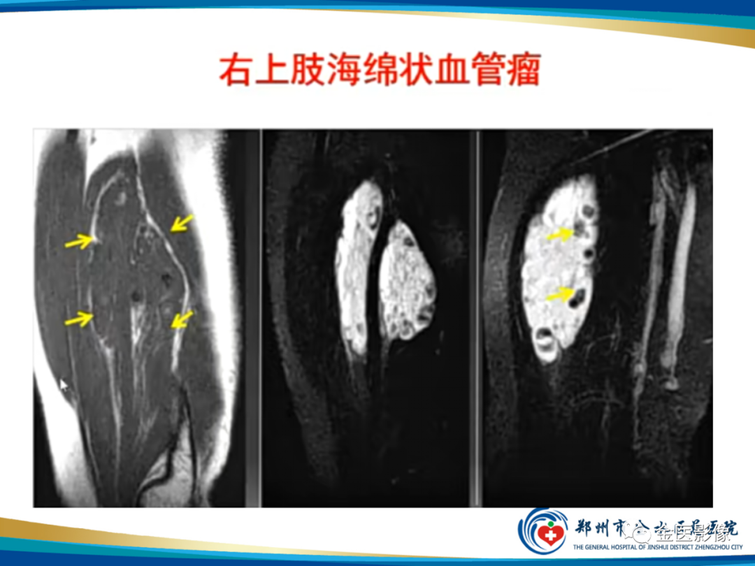影像PPT - 【PPT】软组织肿瘤影像表现与诊断思路-15