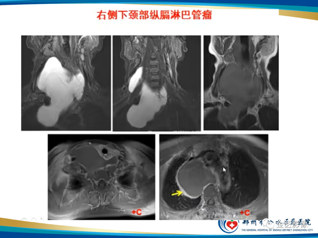 影像PPT - 【PPT】软组织肿瘤影像表现与诊断思路-17