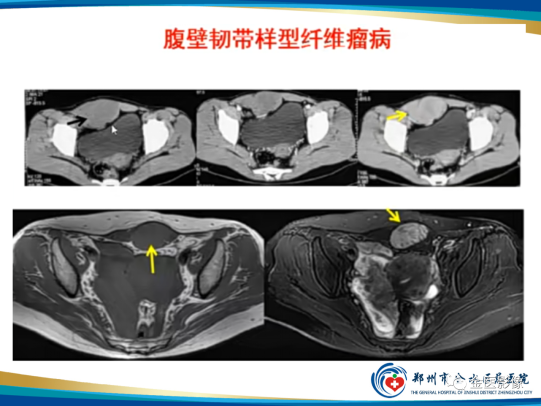 影像PPT - 【PPT】软组织肿瘤影像表现与诊断思路-19