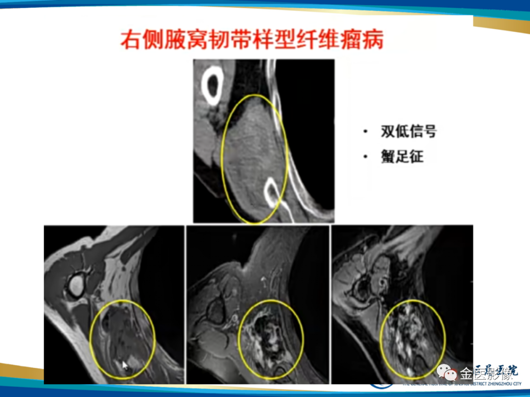 影像PPT - 【PPT】软组织肿瘤影像表现与诊断思路-20