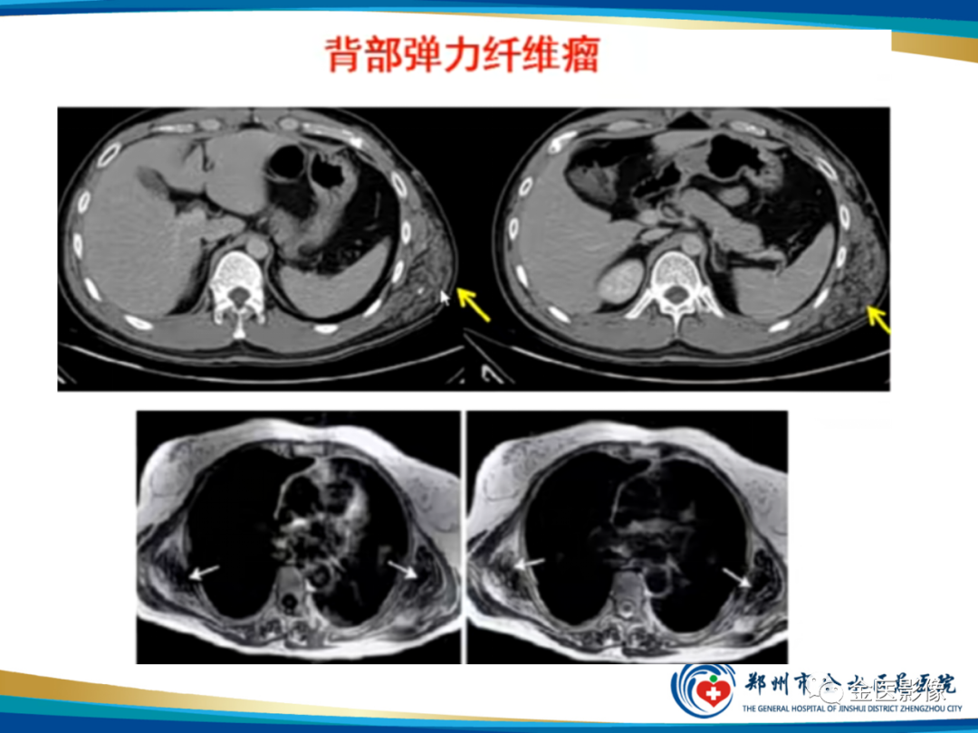 影像PPT - 【PPT】软组织肿瘤影像表现与诊断思路-22