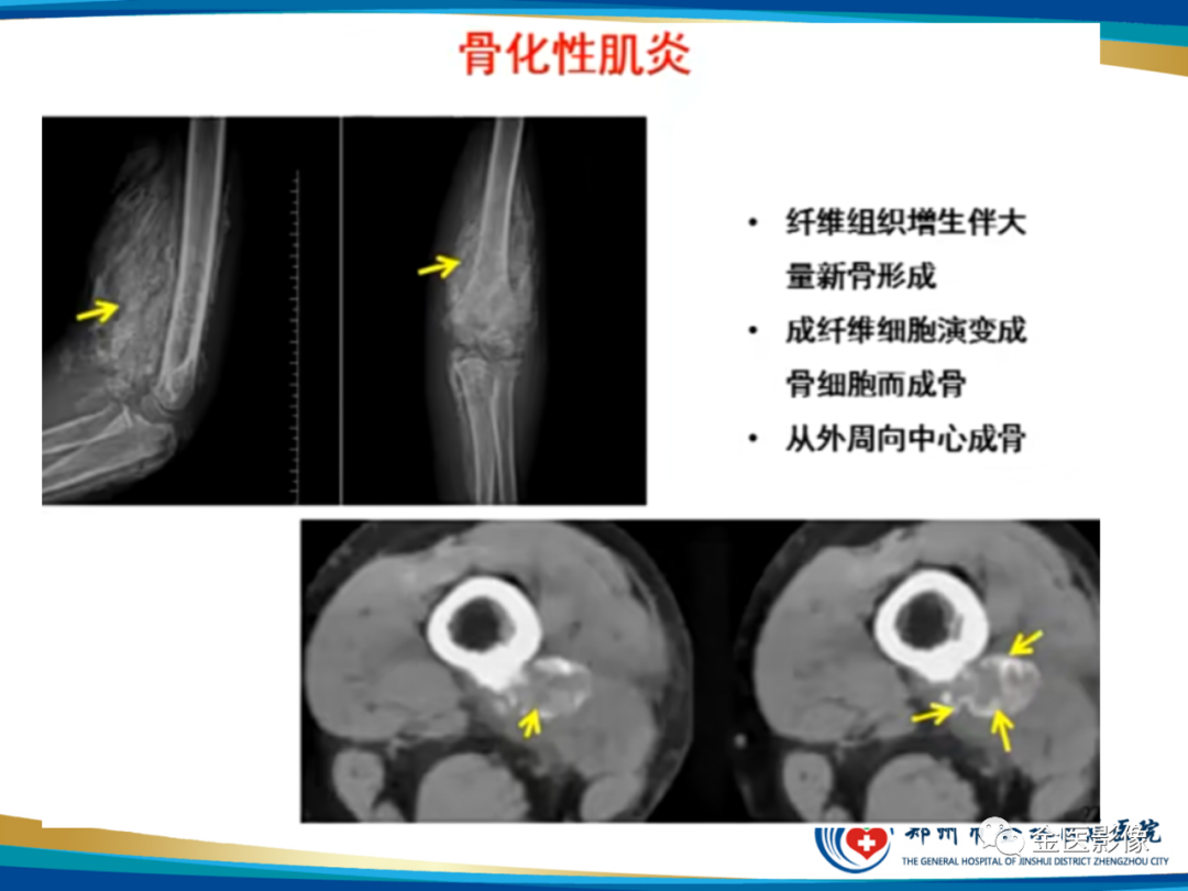 影像PPT - 【PPT】软组织肿瘤影像表现与诊断思路-24
