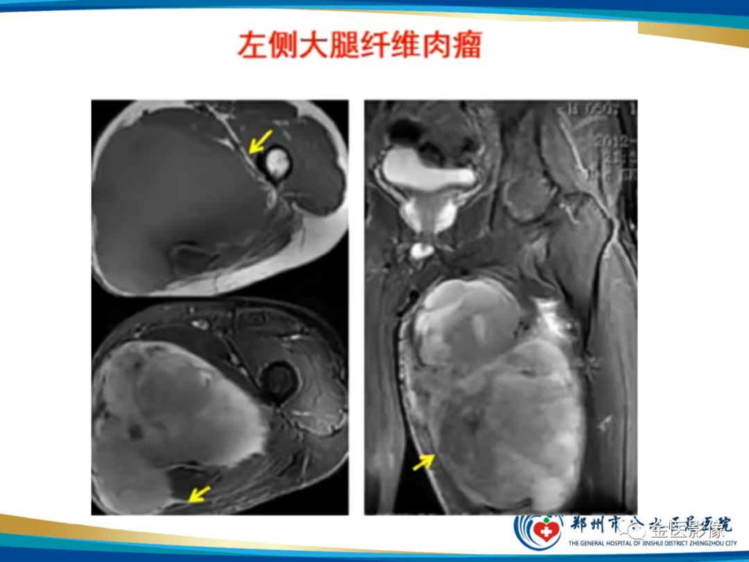 影像PPT - 【PPT】软组织肿瘤影像表现与诊断思路-26