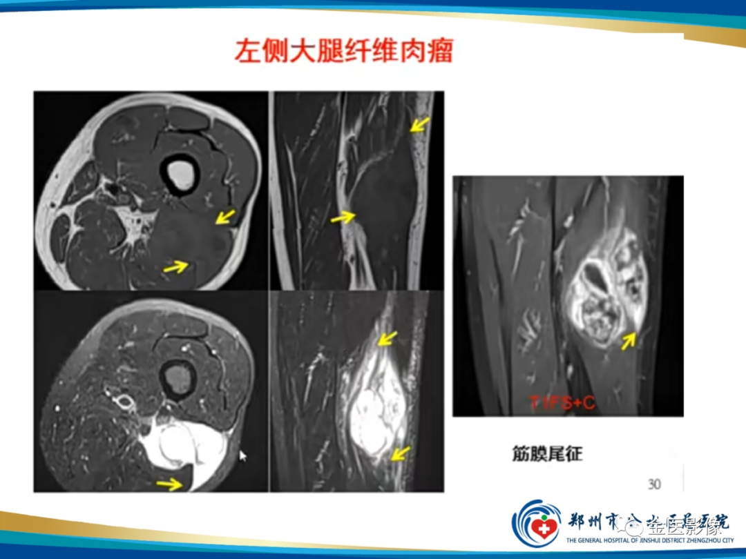 影像PPT - 【PPT】软组织肿瘤影像表现与诊断思路-27