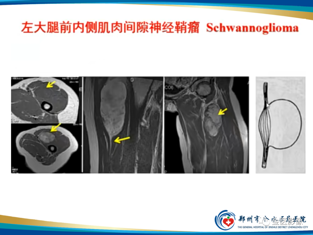 影像PPT - 【PPT】软组织肿瘤影像表现与诊断思路-29