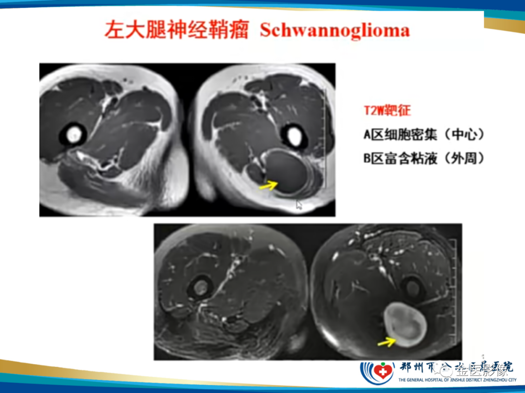 影像PPT - 【PPT】软组织肿瘤影像表现与诊断思路-30