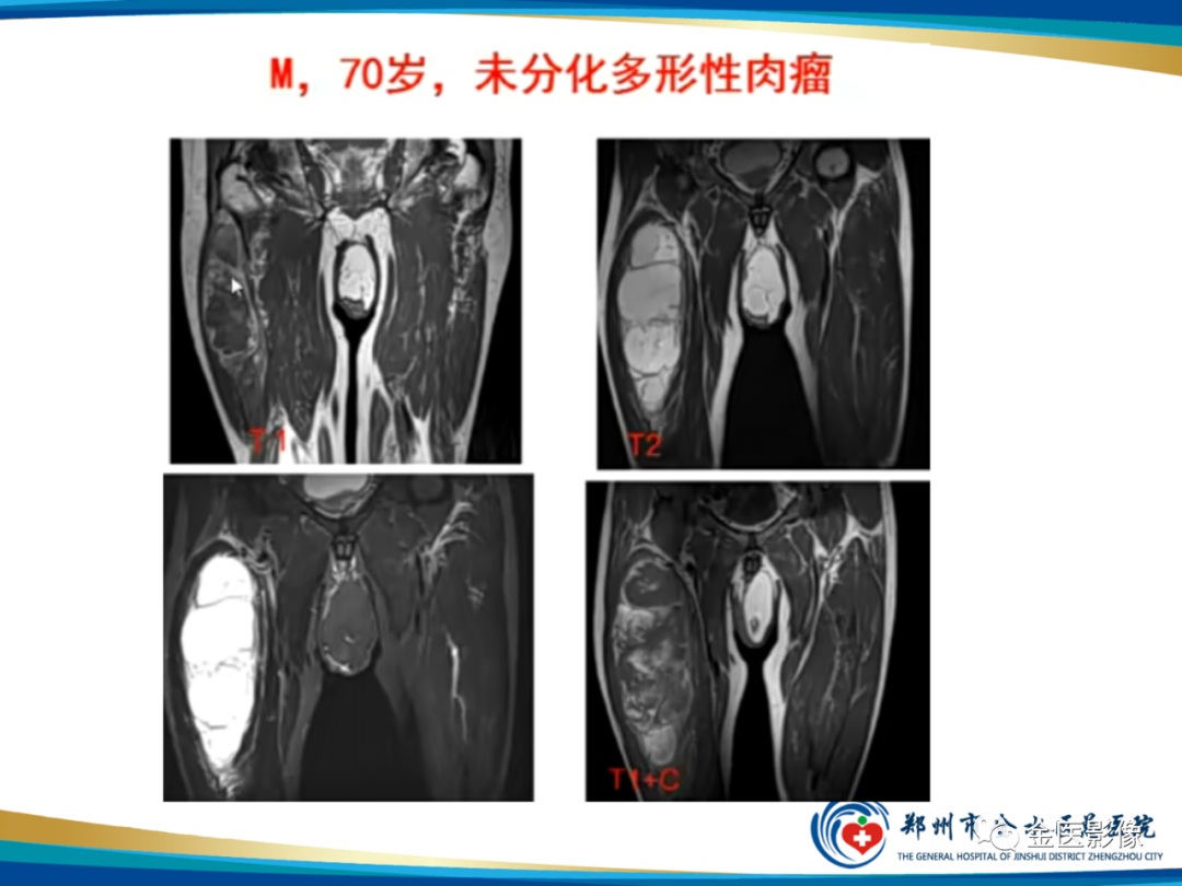 影像PPT - 【PPT】软组织肿瘤影像表现与诊断思路-33