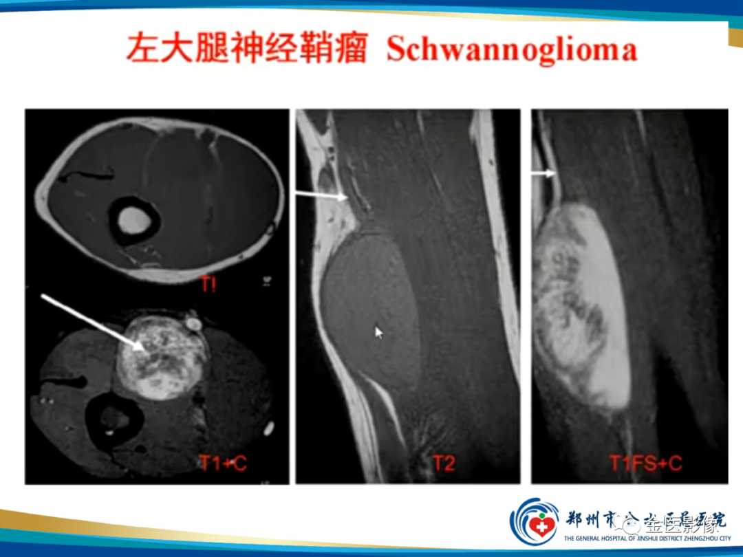影像PPT - 【PPT】软组织肿瘤影像表现与诊断思路-31