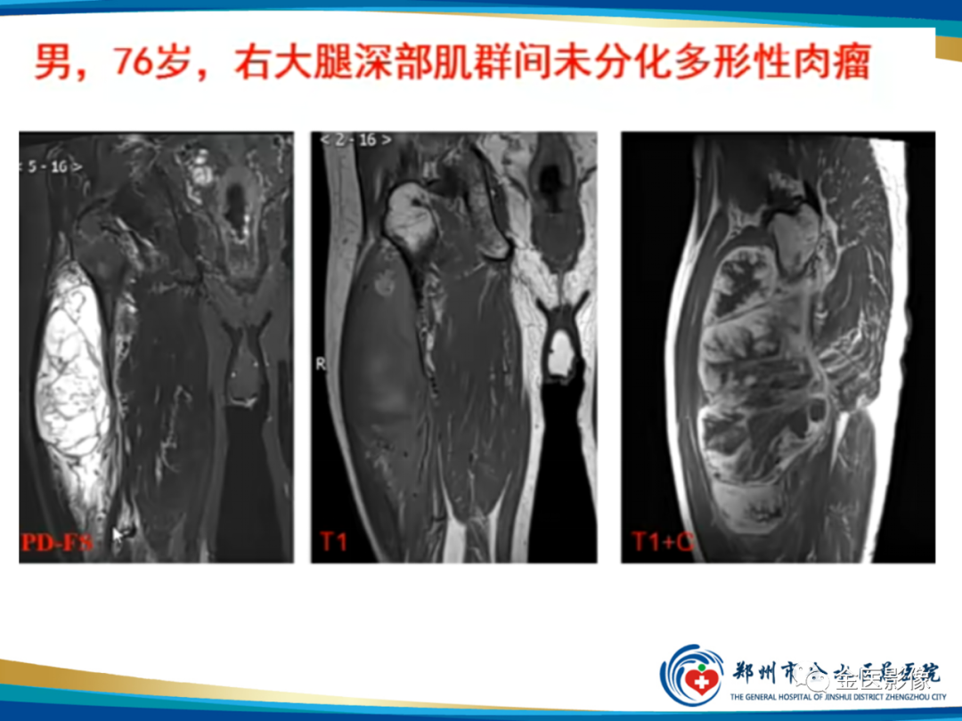 影像PPT - 【PPT】软组织肿瘤影像表现与诊断思路-34