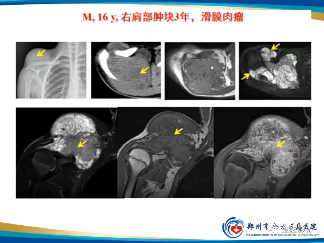 影像PPT - 【PPT】软组织肿瘤影像表现与诊断思路-36