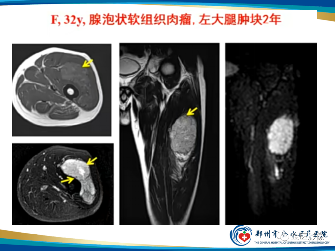 影像PPT - 【PPT】软组织肿瘤影像表现与诊断思路-38