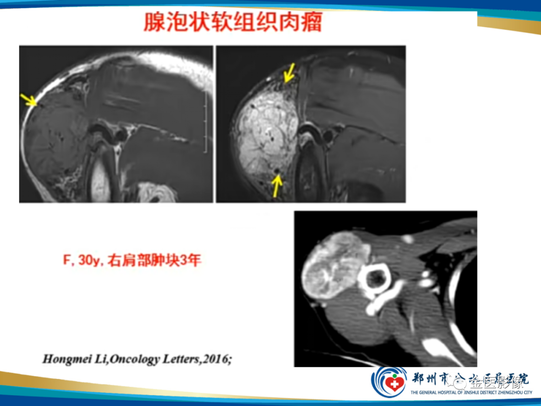 影像PPT - 【PPT】软组织肿瘤影像表现与诊断思路-39