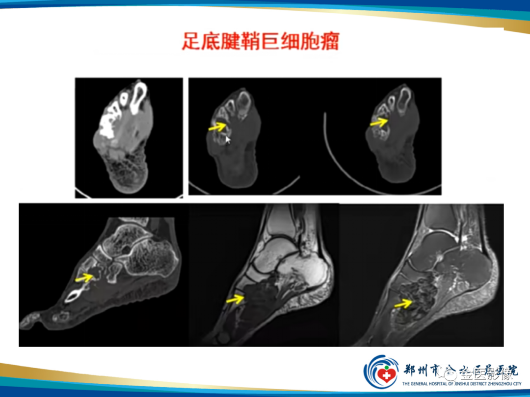 影像PPT - 【PPT】软组织肿瘤影像表现与诊断思路-41