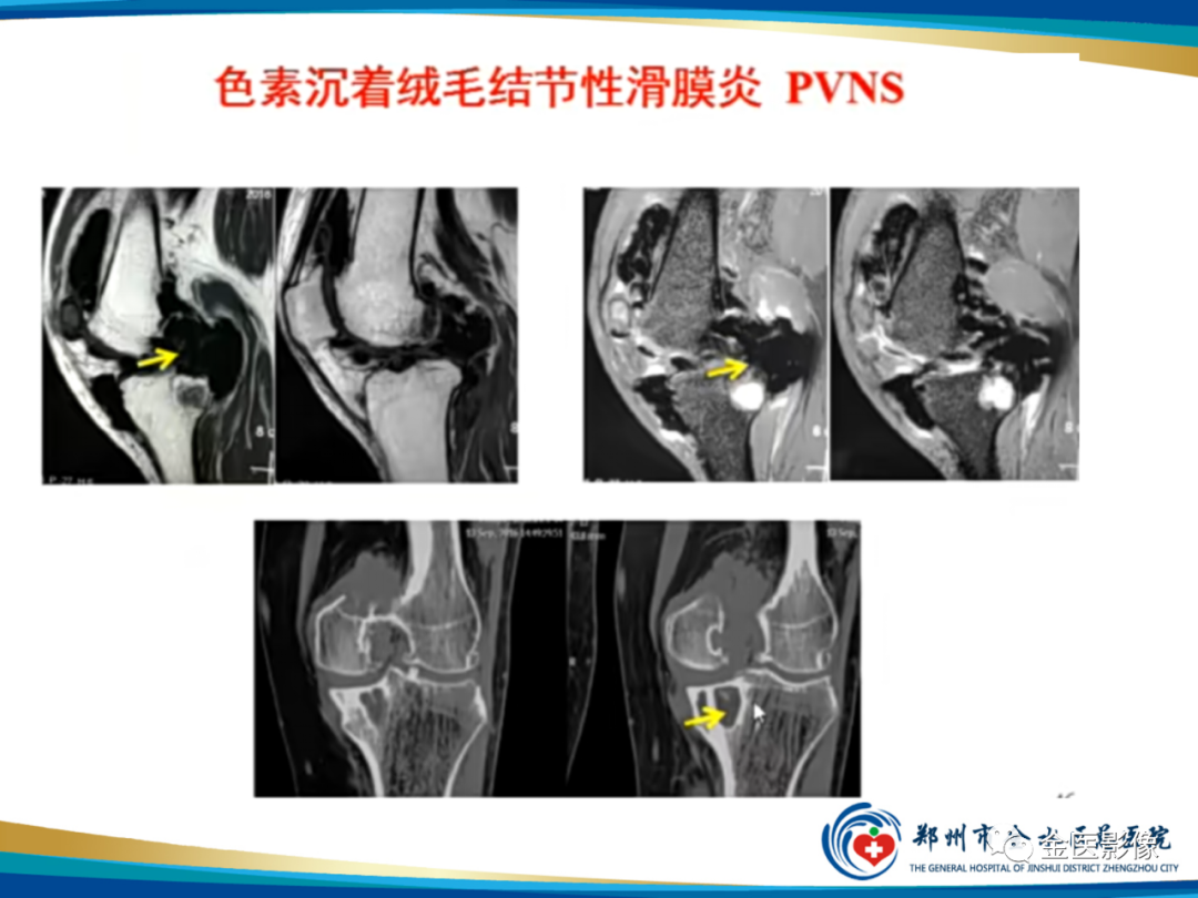 影像PPT - 【PPT】软组织肿瘤影像表现与诊断思路-43