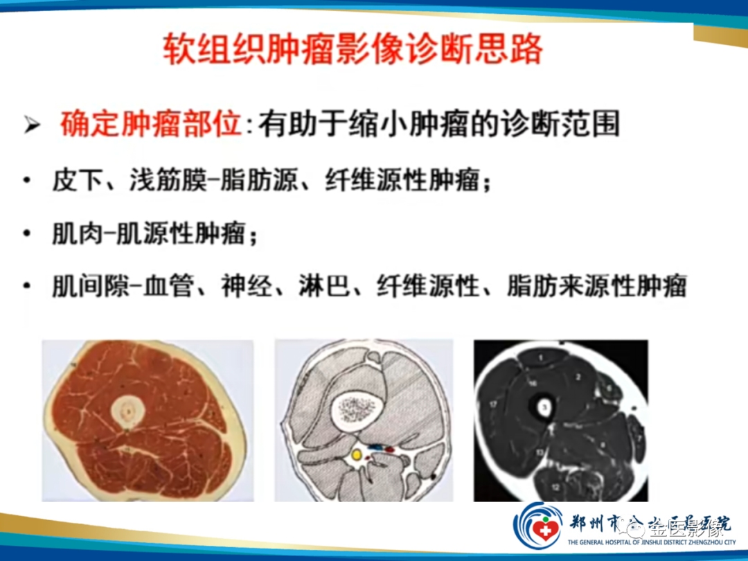 影像PPT - 【PPT】软组织肿瘤影像表现与诊断思路-44