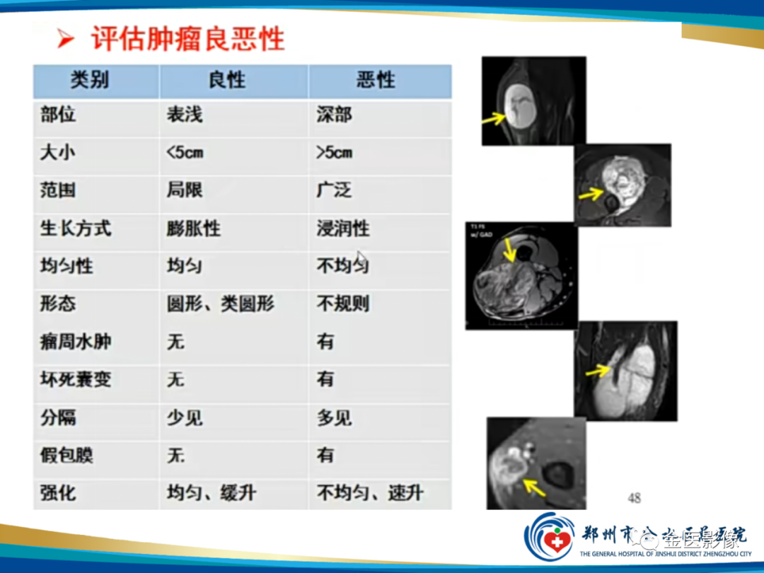 影像PPT - 【PPT】软组织肿瘤影像表现与诊断思路-45