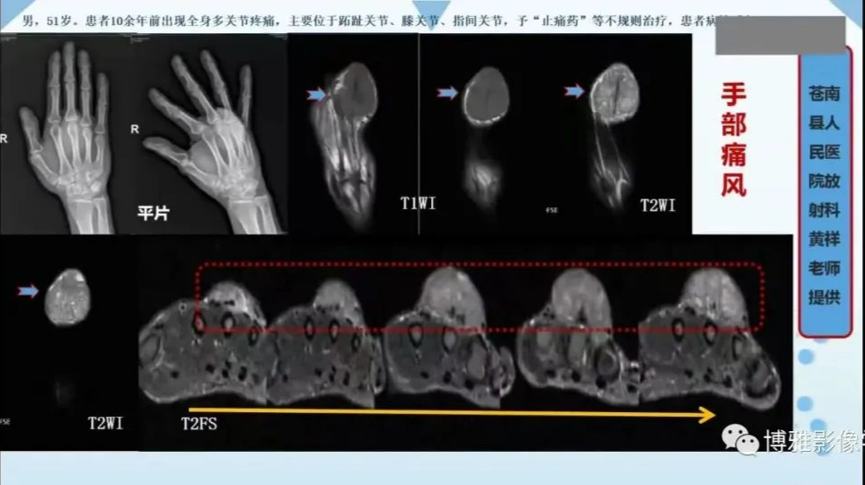 影像PPT - 【PPT】论T2低信号几种腱鞘滑膜疾病-4