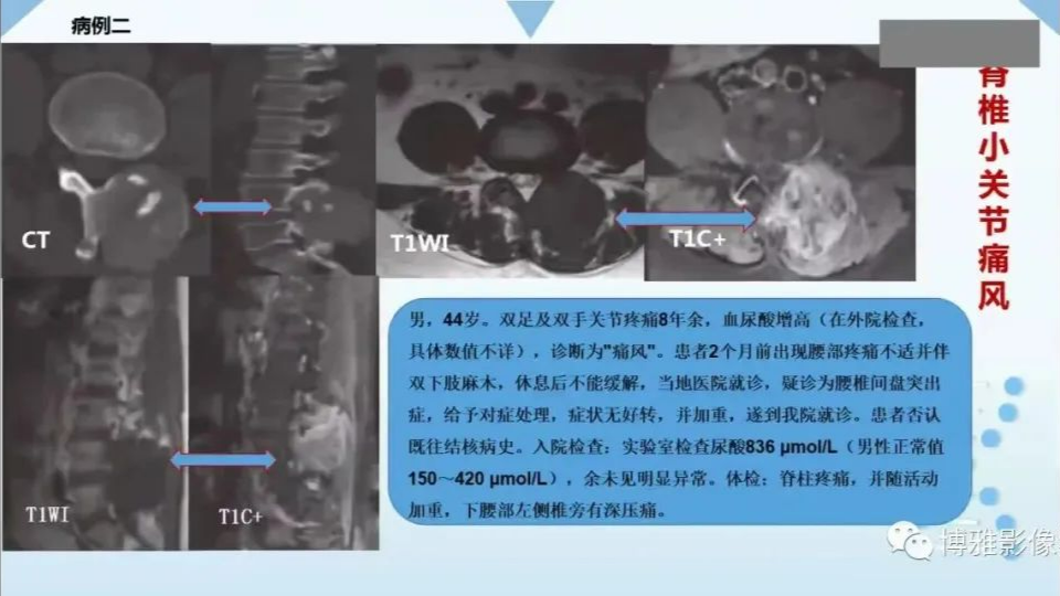 影像PPT - 【PPT】论T2低信号几种腱鞘滑膜疾病-5