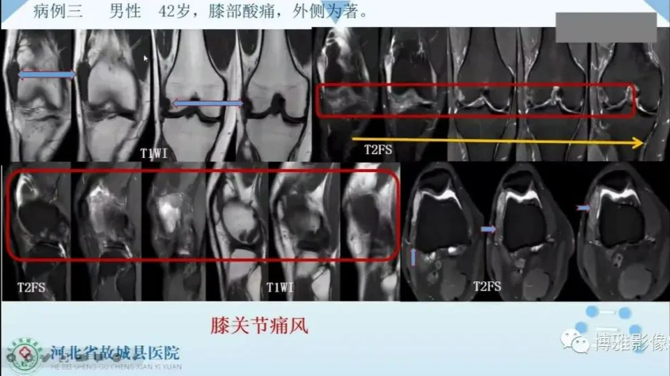 影像PPT - 【PPT】论T2低信号几种腱鞘滑膜疾病-6
