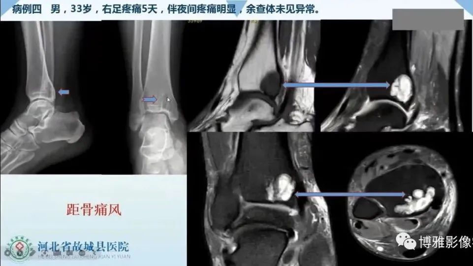 影像PPT - 【PPT】论T2低信号几种腱鞘滑膜疾病-7