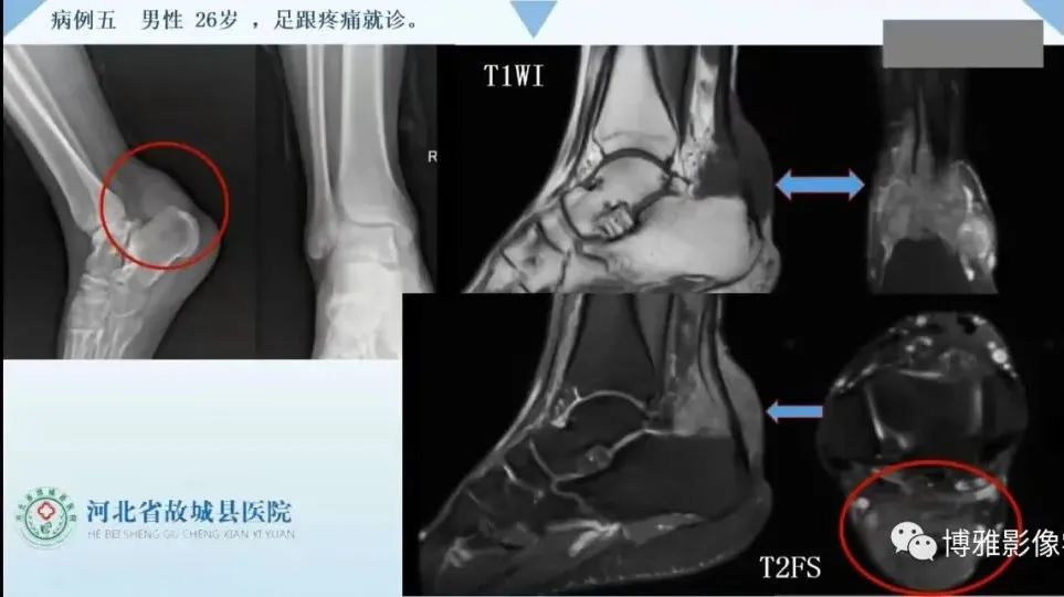 影像PPT - 【PPT】论T2低信号几种腱鞘滑膜疾病-8