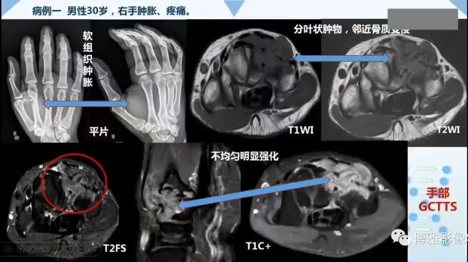 影像PPT - 【PPT】论T2低信号几种腱鞘滑膜疾病-11