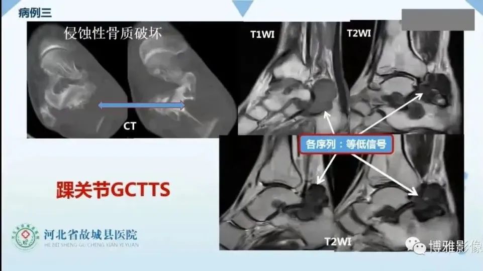 影像PPT - 【PPT】论T2低信号几种腱鞘滑膜疾病-13