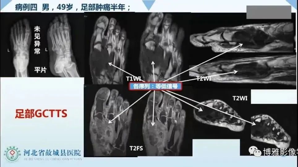 影像PPT - 【PPT】论T2低信号几种腱鞘滑膜疾病-14