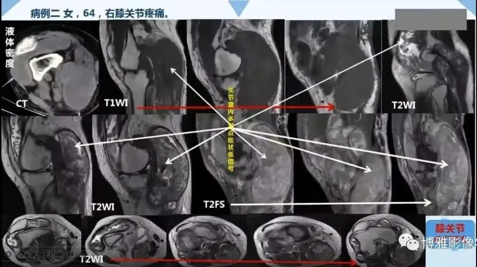 影像PPT - 【PPT】论T2低信号几种腱鞘滑膜疾病-12