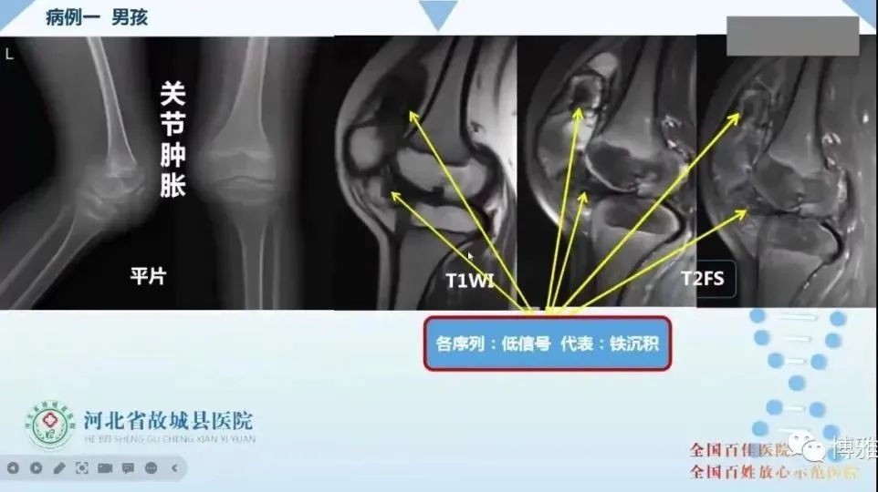 影像PPT - 【PPT】论T2低信号几种腱鞘滑膜疾病-18
