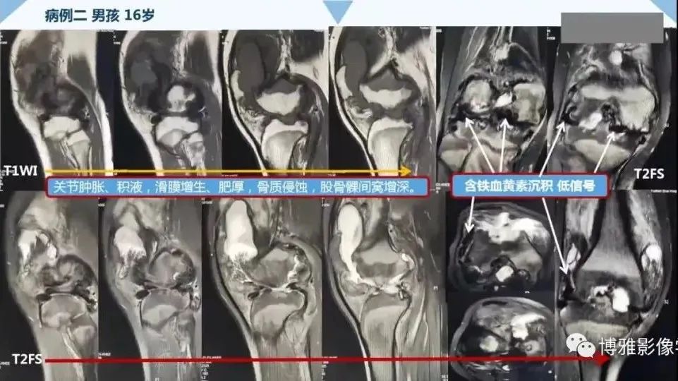 影像PPT - 【PPT】论T2低信号几种腱鞘滑膜疾病-19