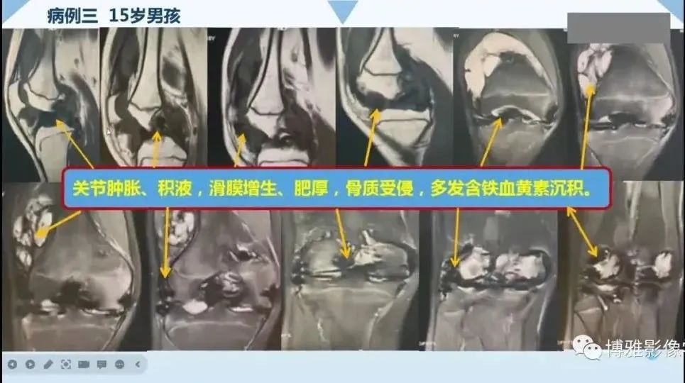 影像PPT - 【PPT】论T2低信号几种腱鞘滑膜疾病-20