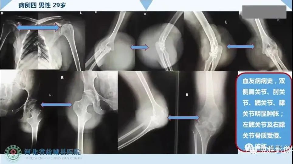 影像PPT - 【PPT】论T2低信号几种腱鞘滑膜疾病-21