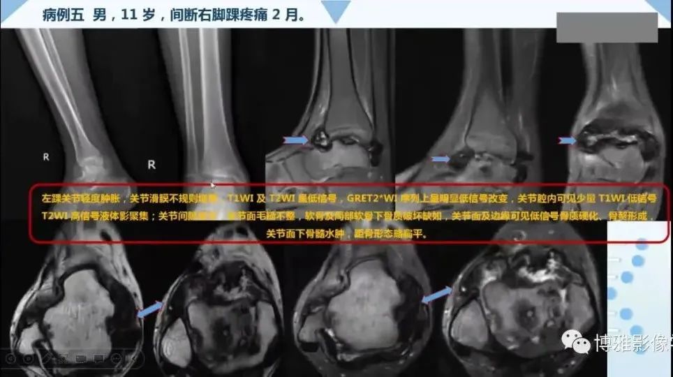 影像PPT - 【PPT】论T2低信号几种腱鞘滑膜疾病-22