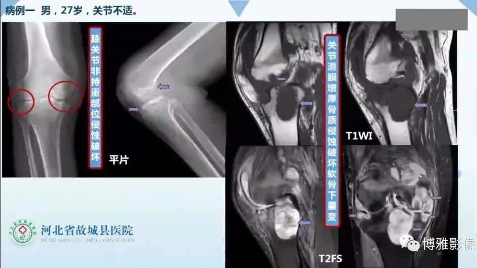 影像PPT - 【PPT】论T2低信号几种腱鞘滑膜疾病-25