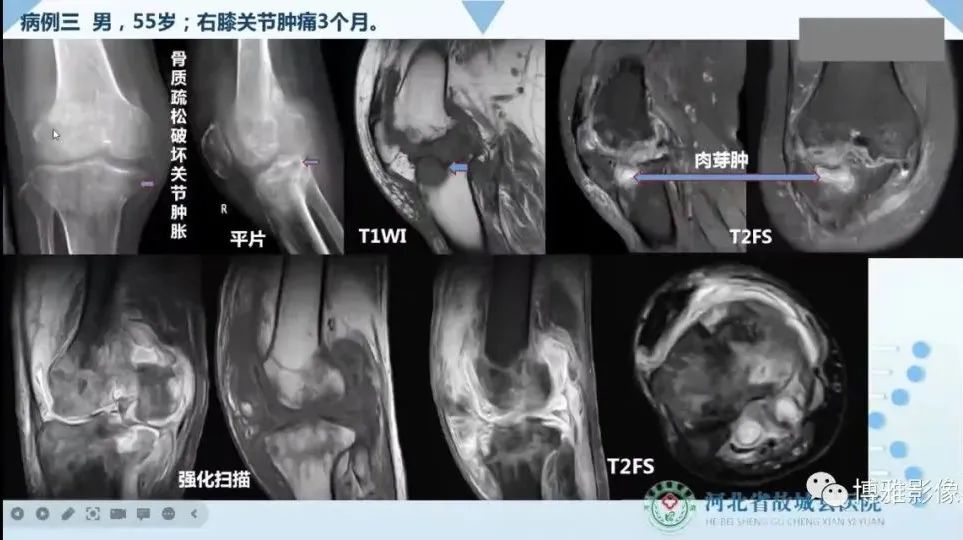 影像PPT - 【PPT】论T2低信号几种腱鞘滑膜疾病-27
